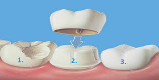 Hermitage Dental Crowns