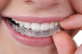 Hermitage Dental Invisalign® Clear Aligners